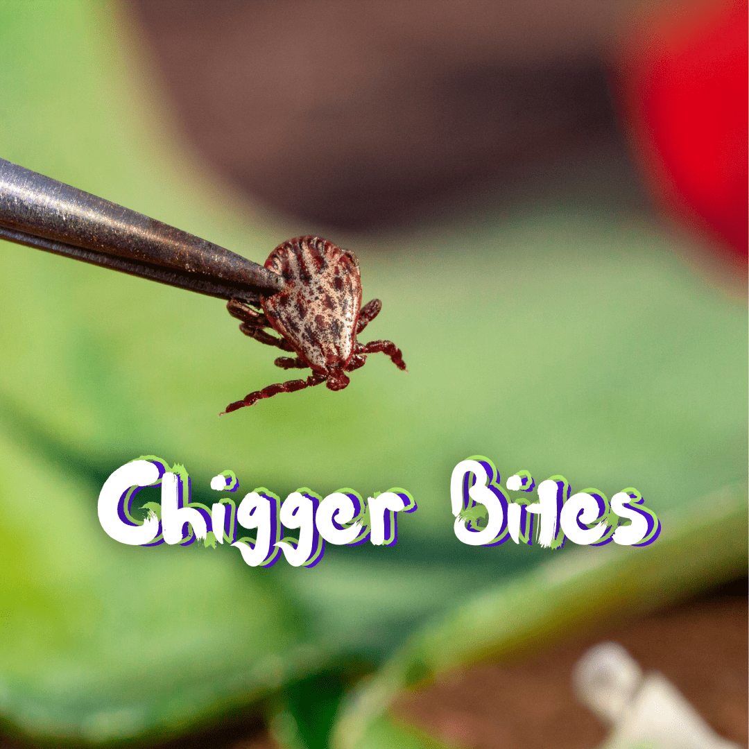 Chigger Bites